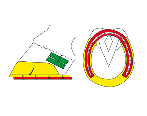 Schematic diagram of the DALLMER Cuff (yellow) with Eggbar Shoe (red) and sandcrack plaster (green) for sandcrack therapy.